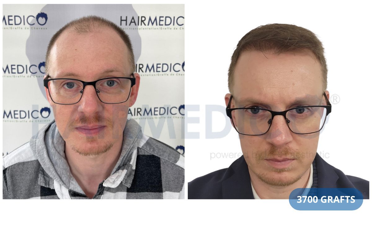 Resultado de trasplante capilar FUE en Hairmedico Clinic antes y después con 3700 injertos