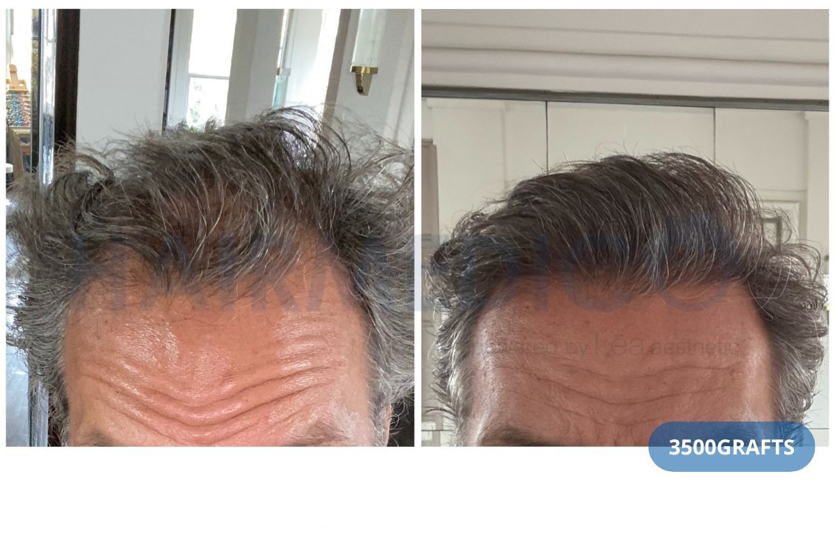 FUE hair transplant before and after result at Hairmedico Clinic, 3500 grafts, improved hairline