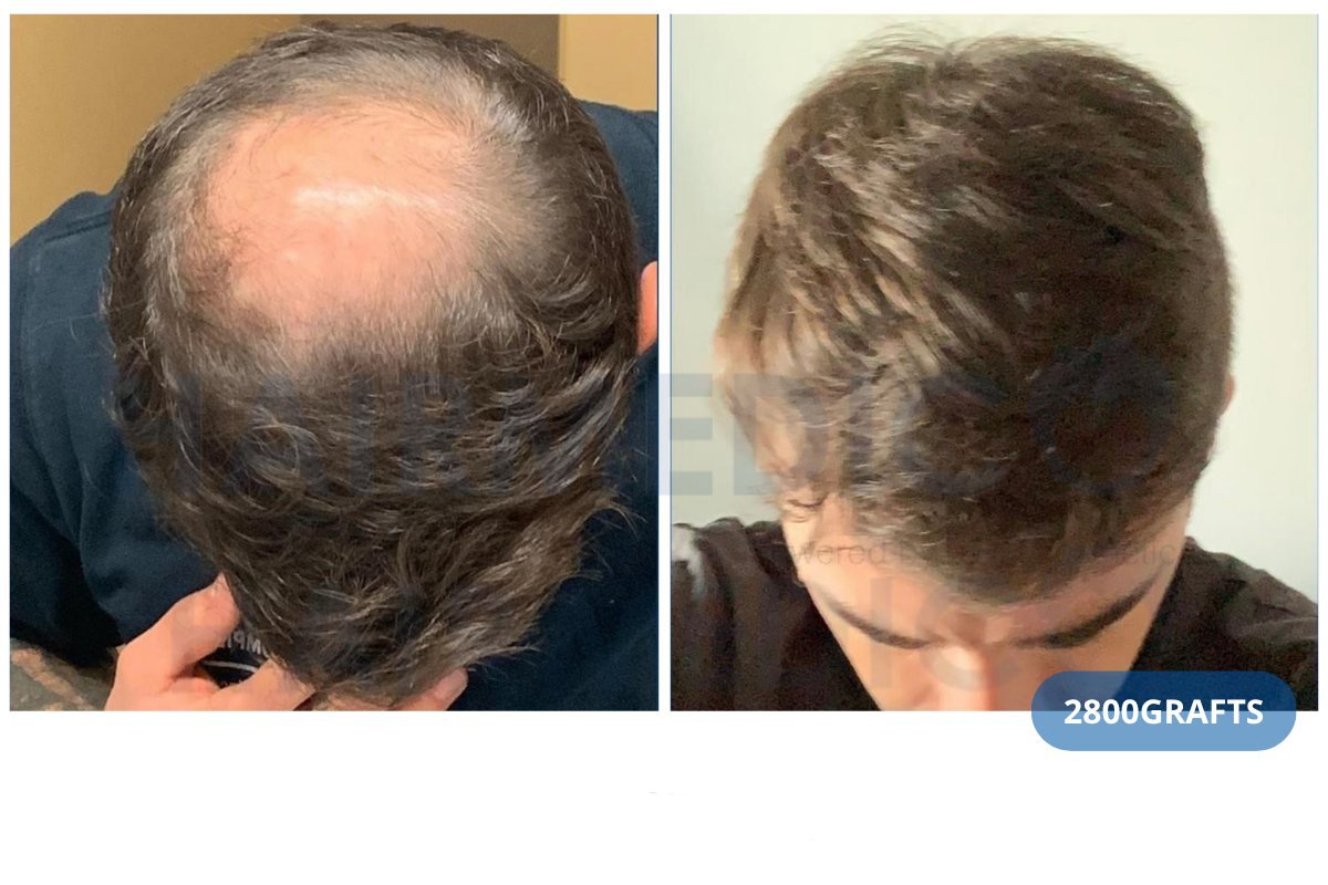 Resultado de trasplante capilar FUE antes y después en Hairmedico Clinic con 2800 injertos