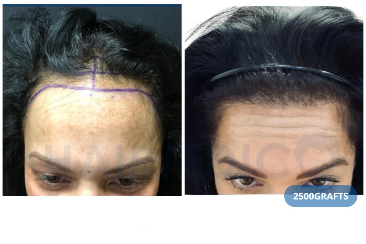 Результат DHI пересадки волос в клинике Hairmedico, 2500 графтов для линии роста