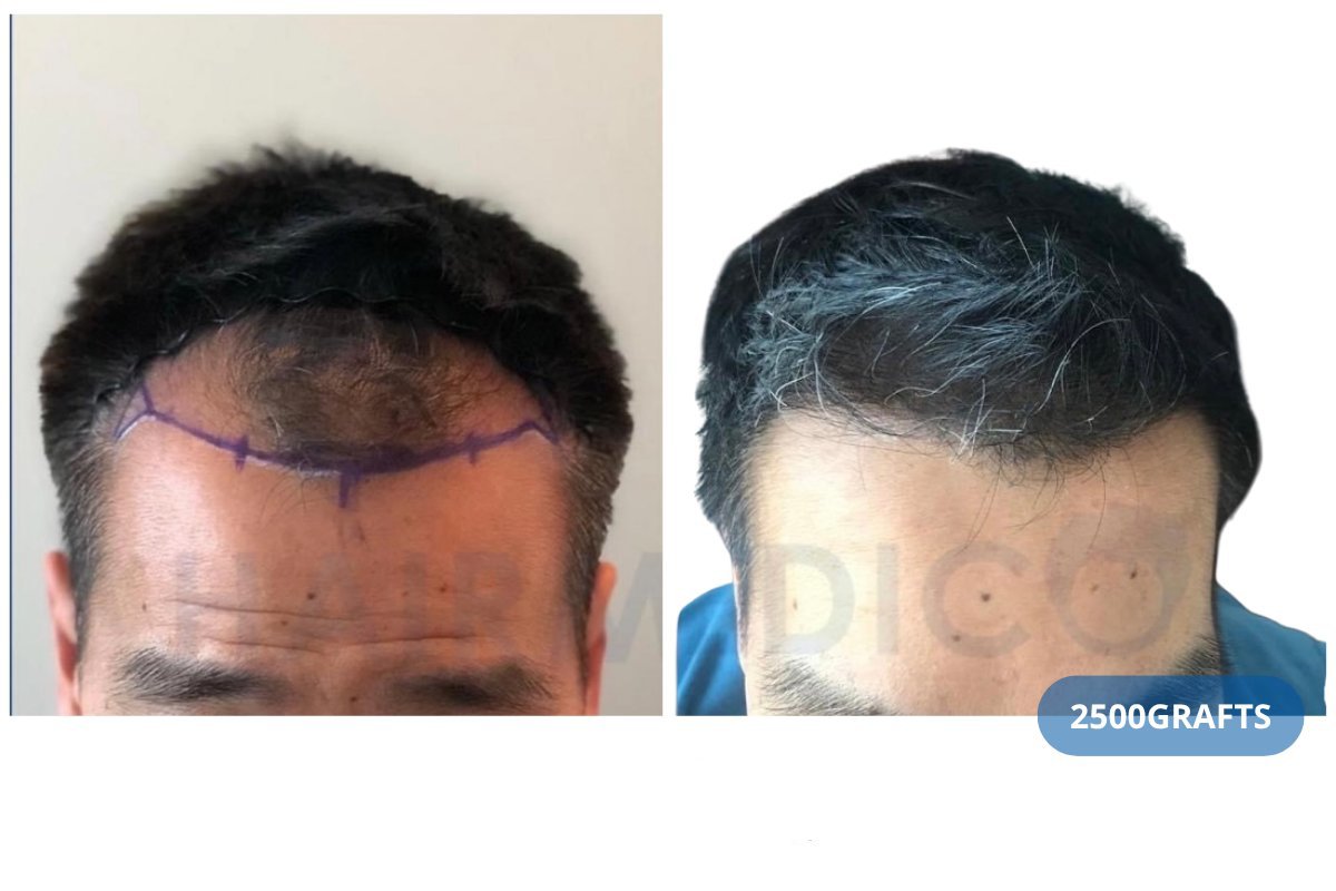 Resultado de trasplante capilar FUE antes y después en Hairmedico Clinic, 2500 injertos