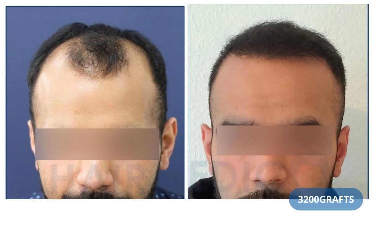 FUE hair transplant before and after result at Hairmedico Clinic, 3200 grafts, improved hairline