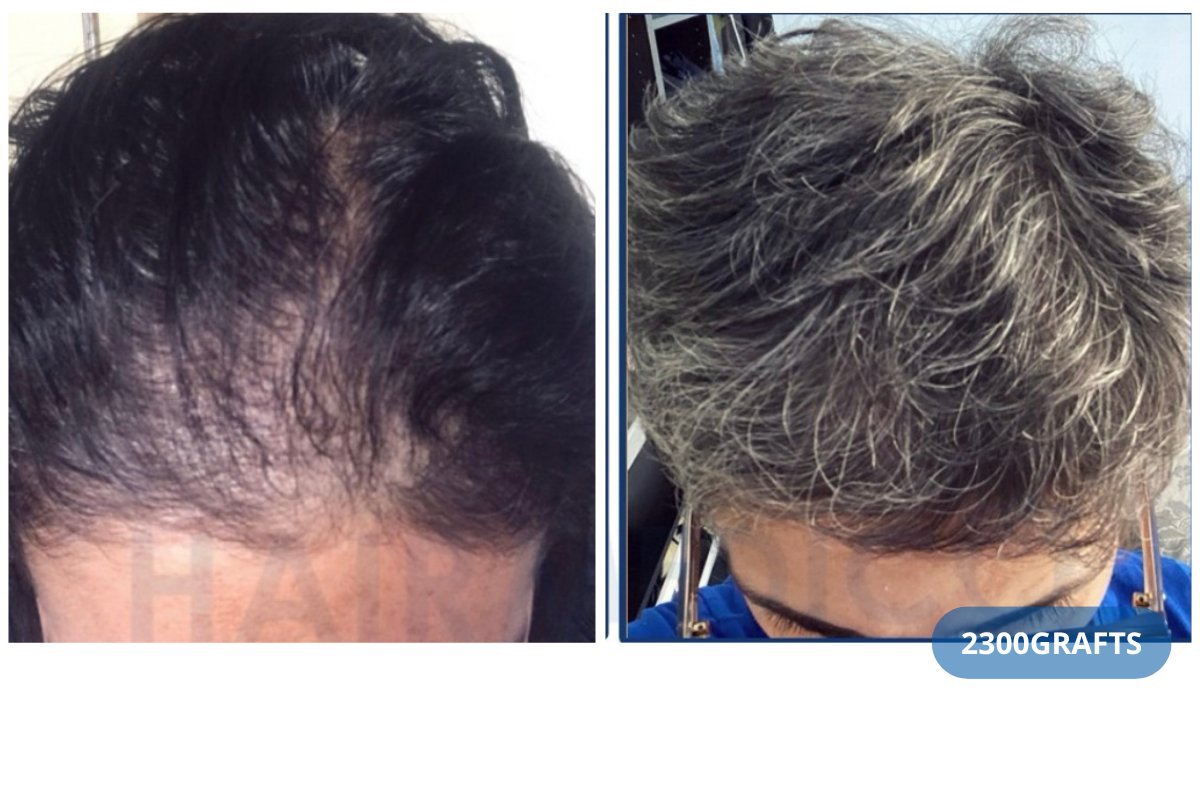 Before and after DHI hair transplant result at Hairmedico Clinic with 2300 grafts used