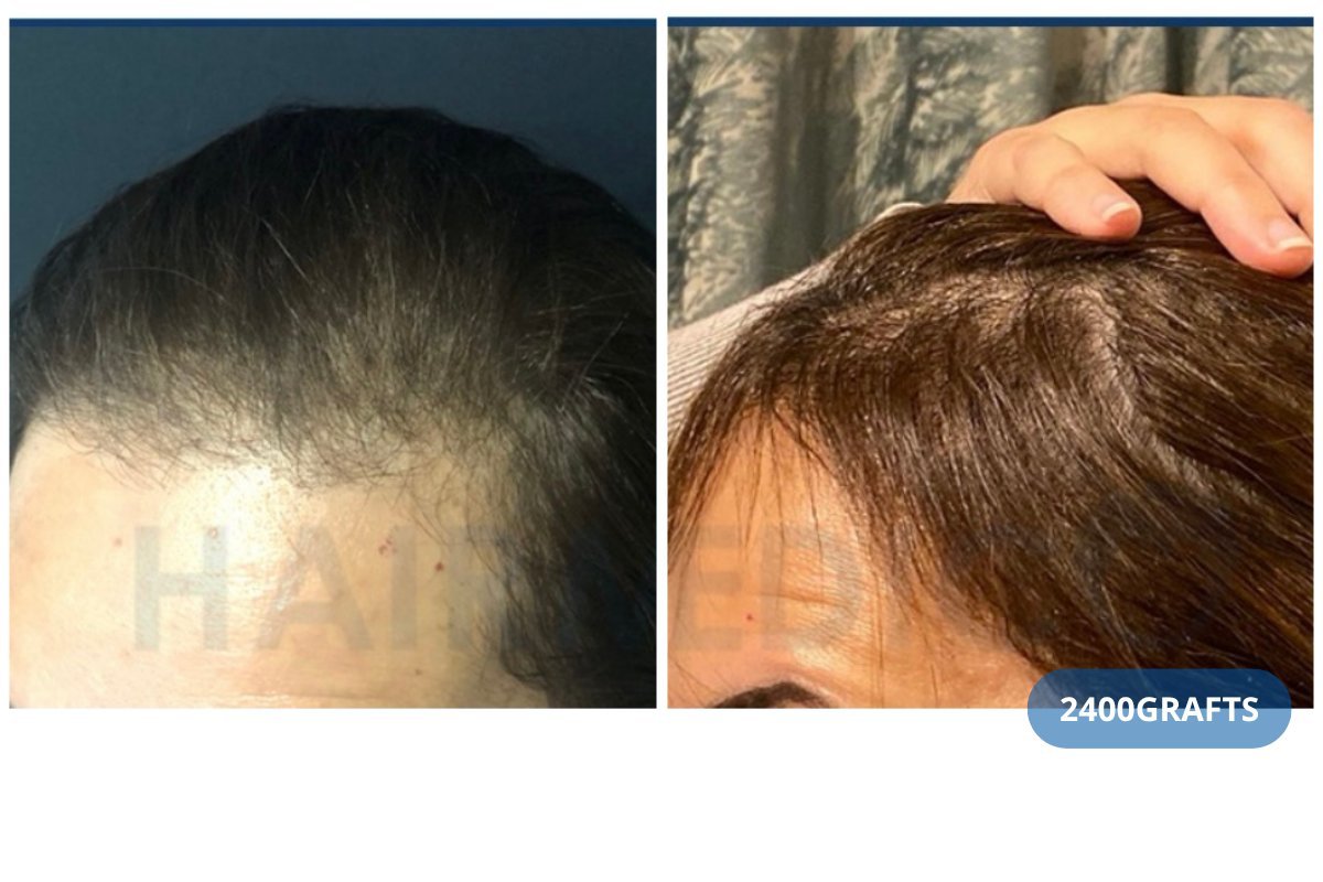 Resultados de trasplante capilar DHI en Hairmedico Clinic, 2400 injertos, línea capilar más densa