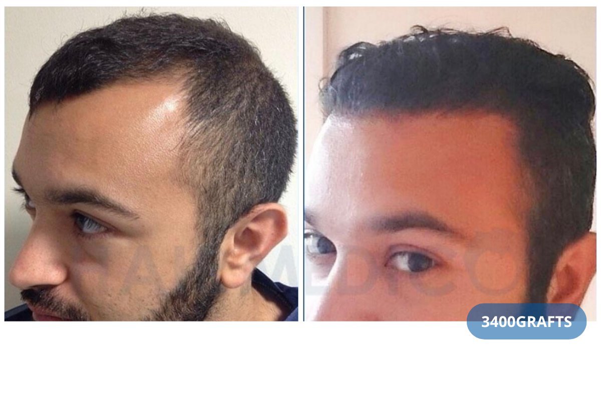 نتيجة زراعة الشعر FUE قبل وبعد في عيادة Hairmedico مع 3400 طعم، خط شعر أكثر كثافة
