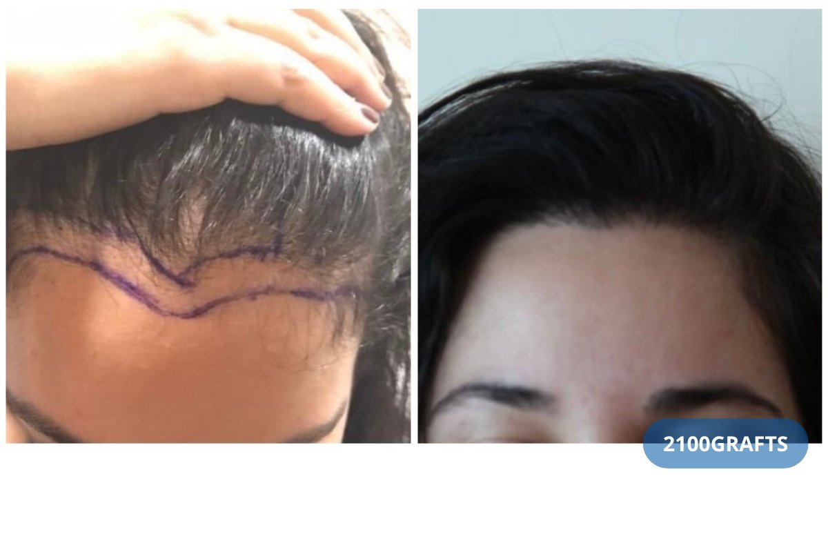 Resultados de trasplante capilar DHI en Hairmedico Clinic, 2100 injertos, línea capilar densa