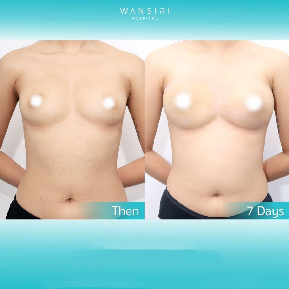 Antes y después de aumento de senos con transferencia de grasa en Wansiri Hospital, 7 días