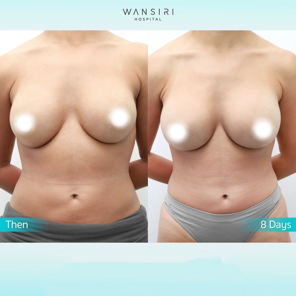 Antes y después de aumento de senos con transferencia de grasa en Wansiri Hospital, 8 días