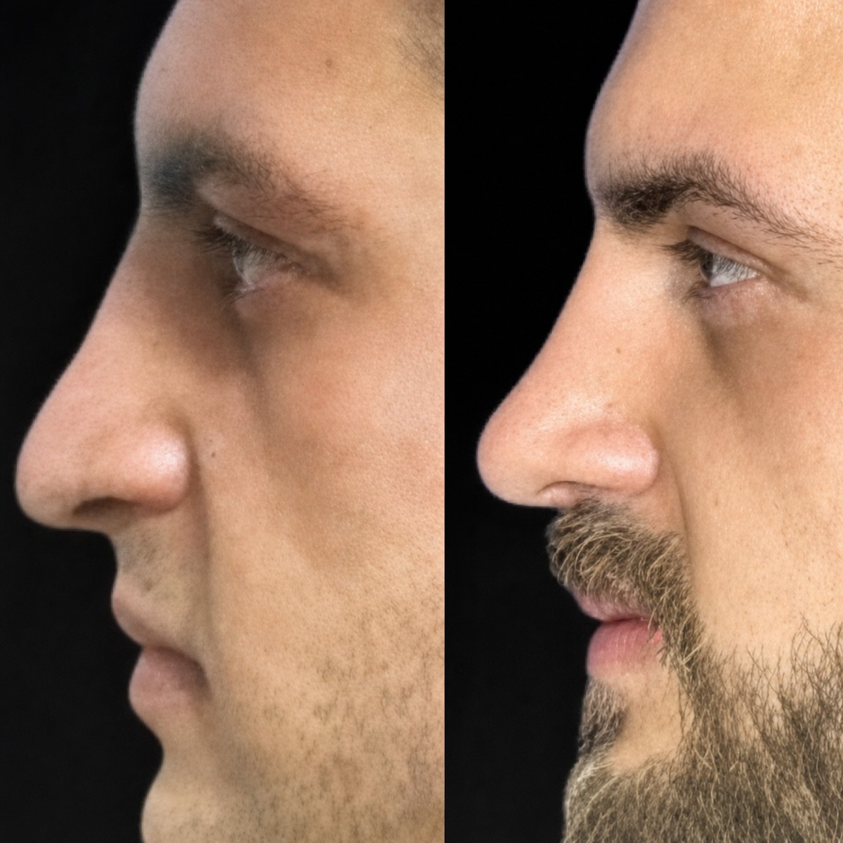 Before and after ultrasonic rhinoplasty results at Memorial Şişli Hospital, improved nose shape