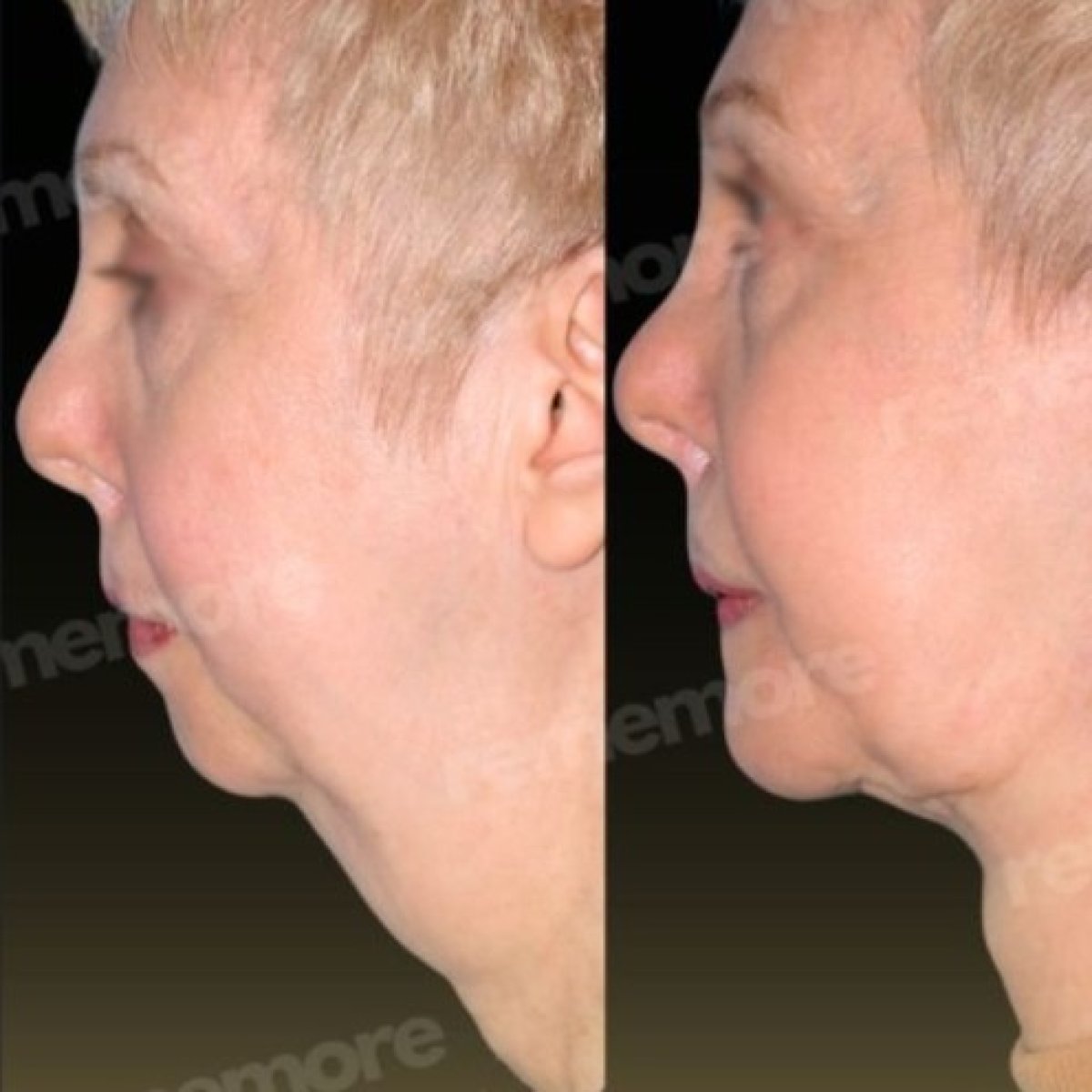 Before and after jaw shaping results at Memorial Şişli Hospital, improved chin contour visible