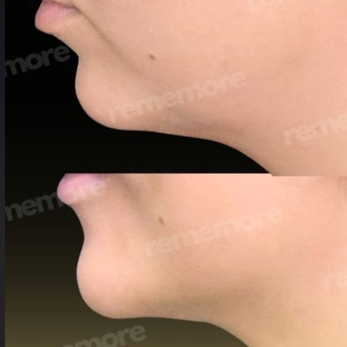 Before and after jaw shaping results at Memorial Şişli Hospital, improved chin contour