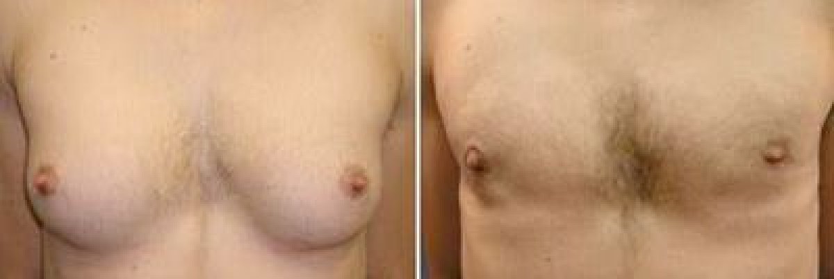 Female to male (FTM) surgery before and after results at Asia Cosmetic Hospital, chest masculinization