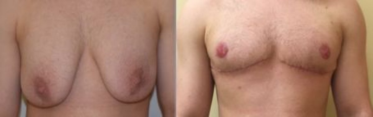 Female to male (FTM) surgery before and after results at Asia Cosmetic Hospital, chest masculinization
