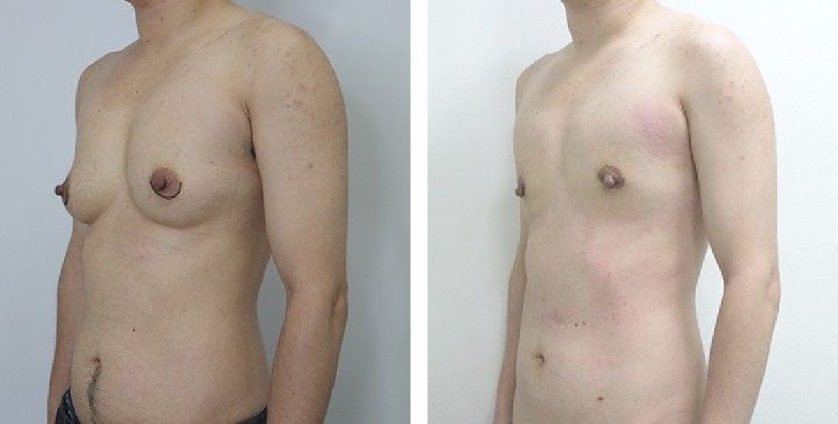 Результаты до и после FTM топ-операции в Asia Cosmetic Hospital, маскулинизация груди