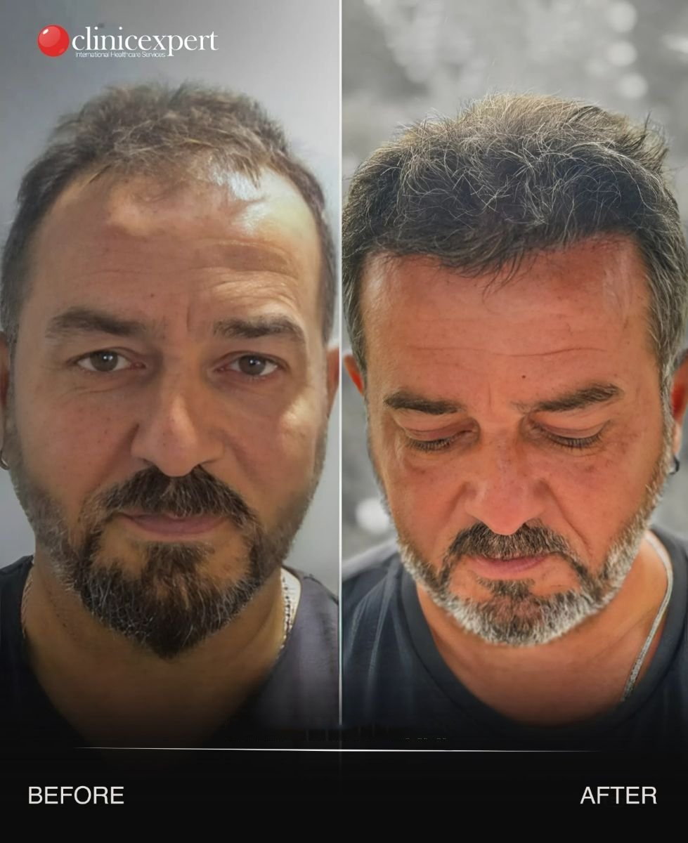 نتيجة زراعة الشعر قبل وبعد في CE International Hospital، كثافة شعر محسنة