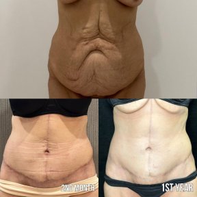 Premium Tummy Tuck and BBL with 360 vaser Liposuction + Breast lifting with Mentor implants ® All Included package - photo 5