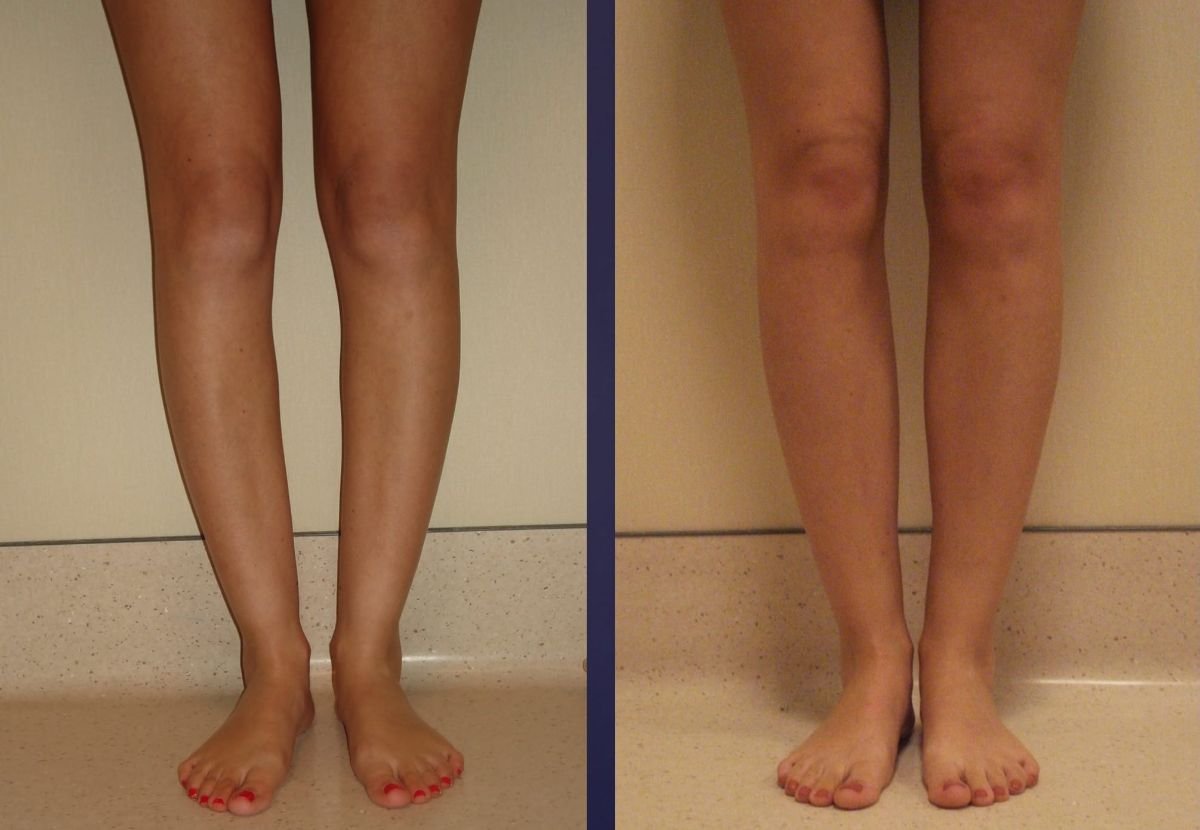 Before and after calf implants at Memorial Ataşehir Hospital, enhanced lower leg contour result