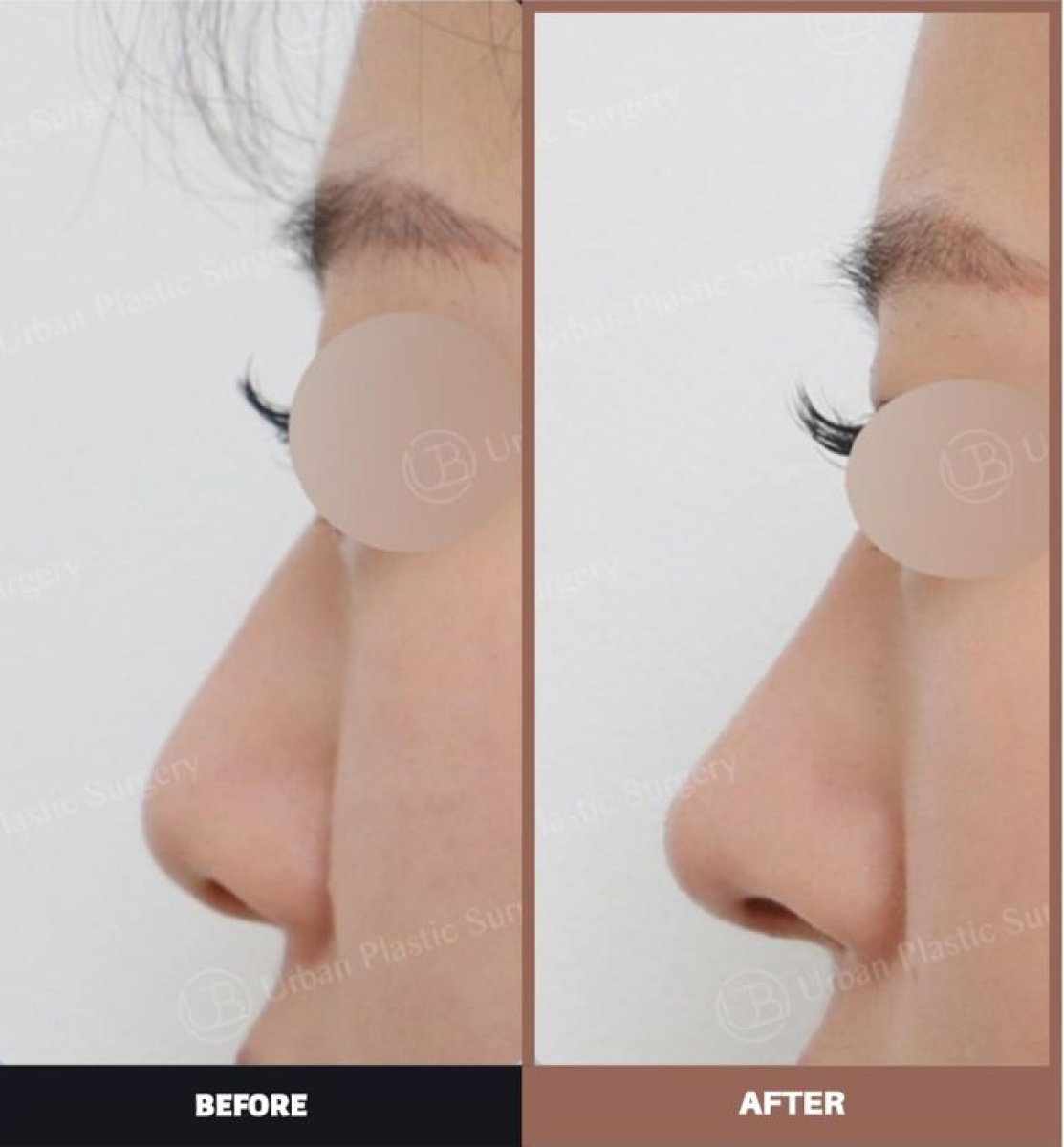 نتائج قبل وبعد عملية تصحيح الحاجز الأنفي في URBAN Plastic Surgery وتحسن شكل الأنف