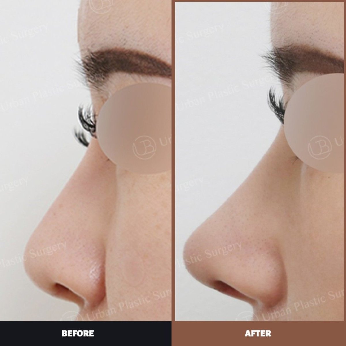Resultados antes y después de septoplastia en URBAN Plastic Surgery, perfil nasal mejorado