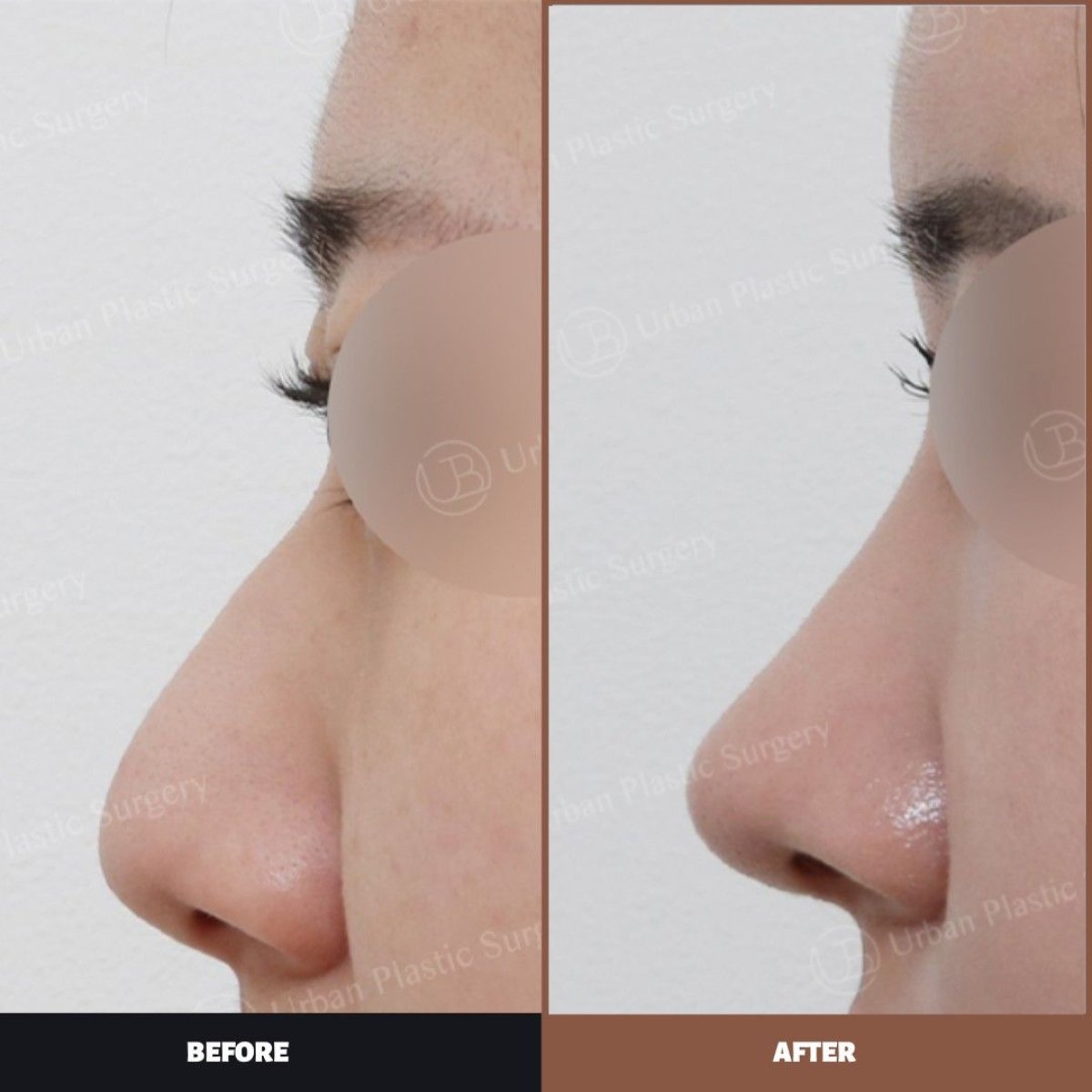 Resultados de septoplastia antes y después en URBAN Plastic Surgery para tabique desviado