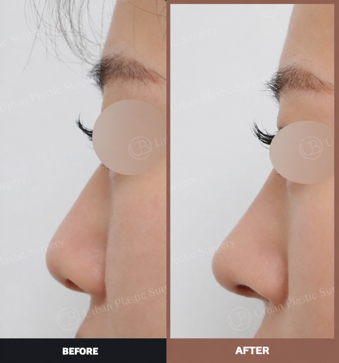 نتائج قبل وبعد عملية تصغير فتحات الأنف في URBAN Plastic Surgery، تحسين شكل الأنف