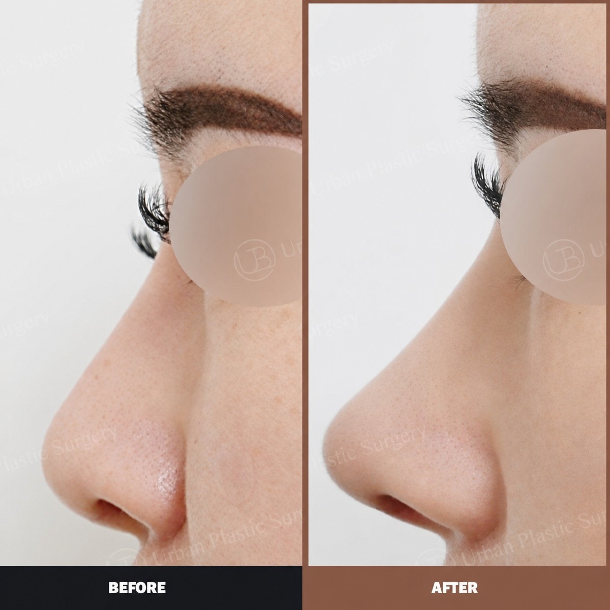 Resultados antes y después de alarplastia en URBAN Plastic Surgery, refinamiento de fosas nasales