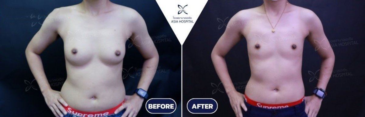 Before and after MTF top surgery results at Asia Cosmetic Hospital, chest contour transformation