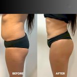 Before and after رفع المؤخرة البرازيلية photos by Dr. Dr Phatcharasak Kraisornphongsakul Md