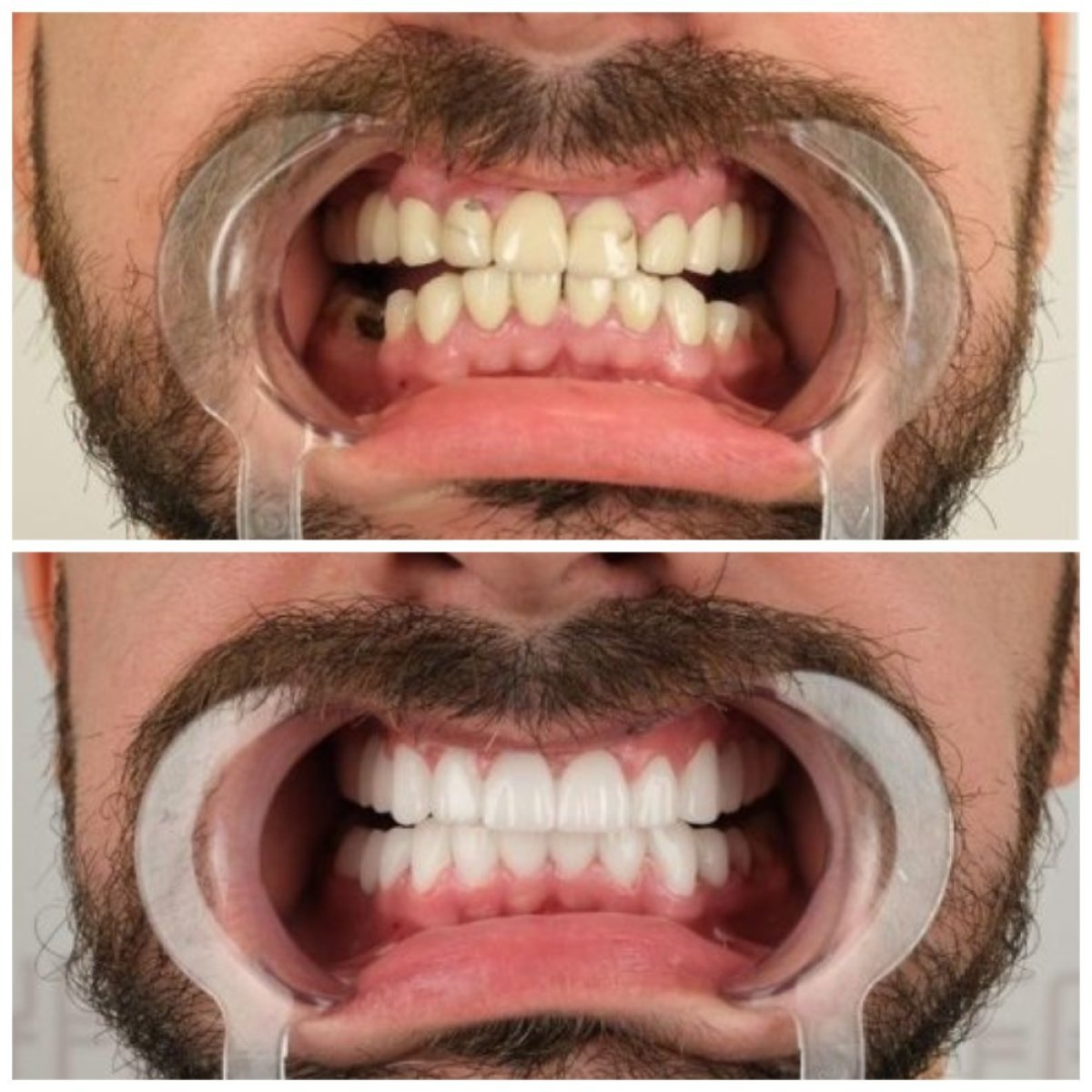 Résultats avant/après smile makeover à YEG Clinic – alignement et couleur des dents améliorés