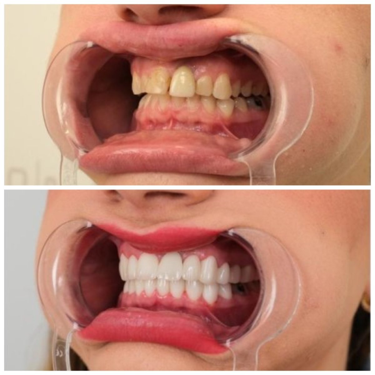 Before and after smile makeover at YEG Clinic, dental veneers for whiter, aligned teeth result