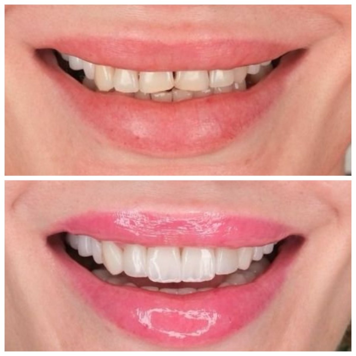 Результати до і після Smile makeover у YEG Clinic – вирівнювання та відбілювання зубів