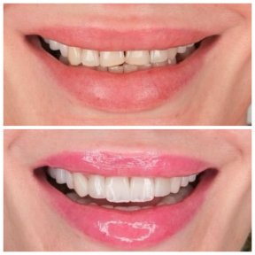 Hollywood Smile with 5-Year Warranty — 5 stars Hotel & VIP Transfer Included - photo 4