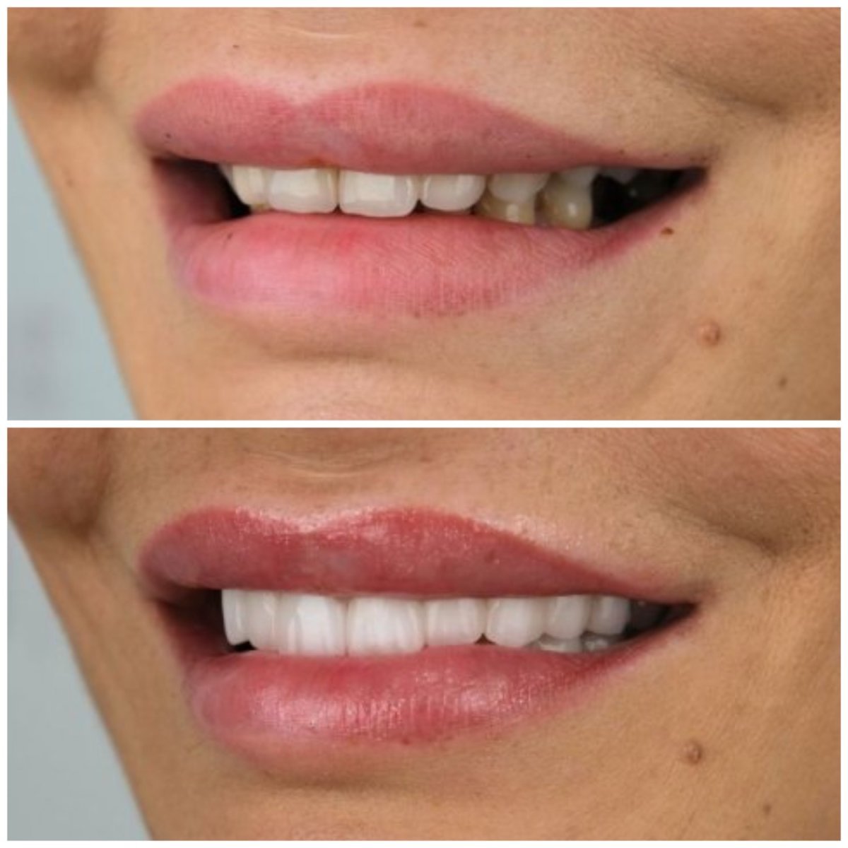 Resultados de antes y después de smile makeover en YEG Clinic: mejor alineación y color dental