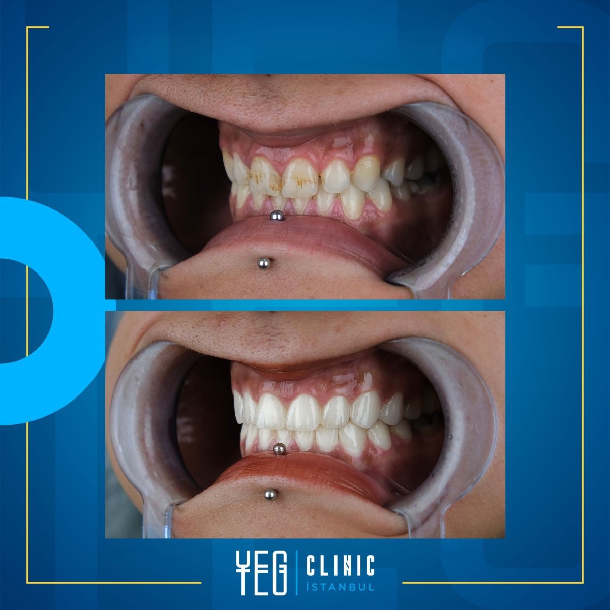 Smile-Makeover Vorher-Nachher-Ergebnis bei YEG Clinic – bessere Zahnfarbe und Ausrichtung