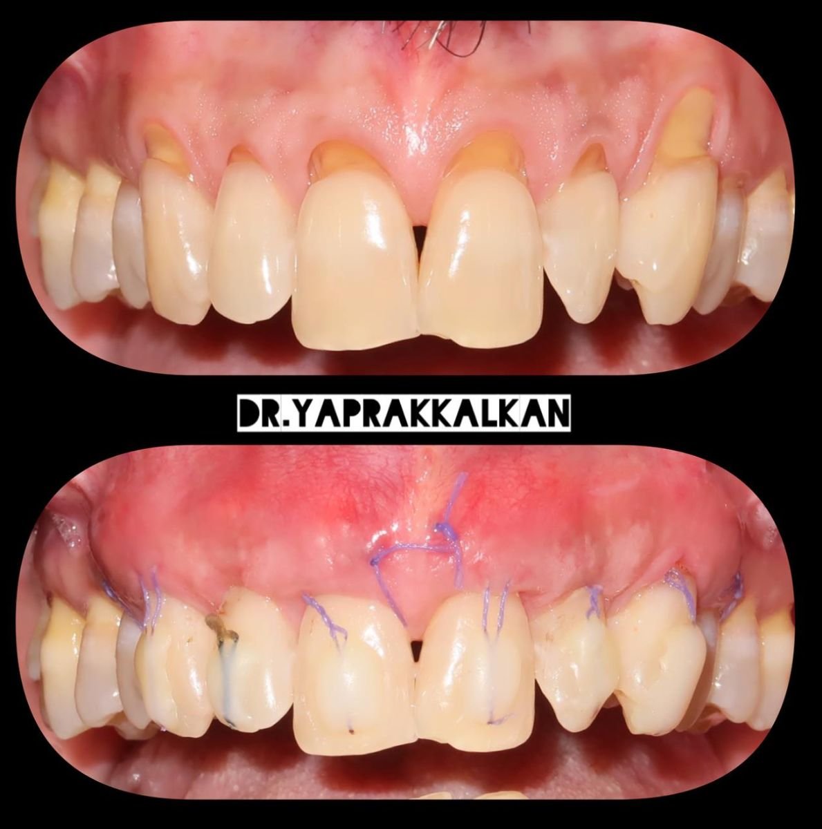 نتائج قبل وبعد جراحة اللثة في Esthetic Smile Academy، تحسين مظهر خط اللثة