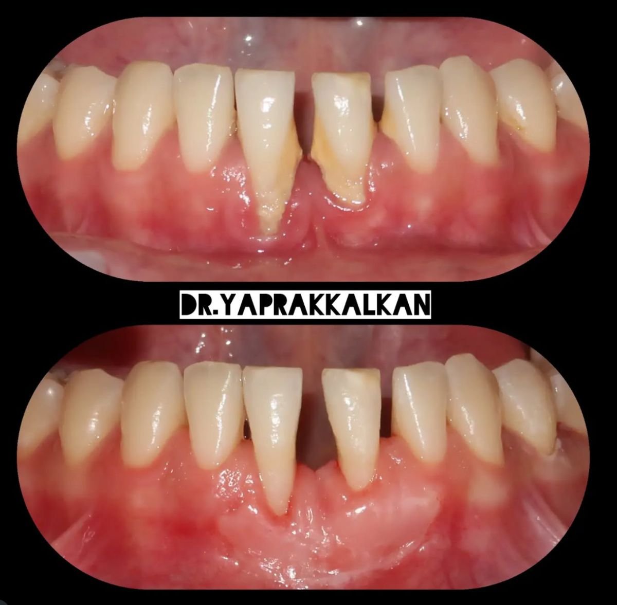 Résultats avant/après chirurgie des gencives à Esthetic Smile Academy – gencives améliorées