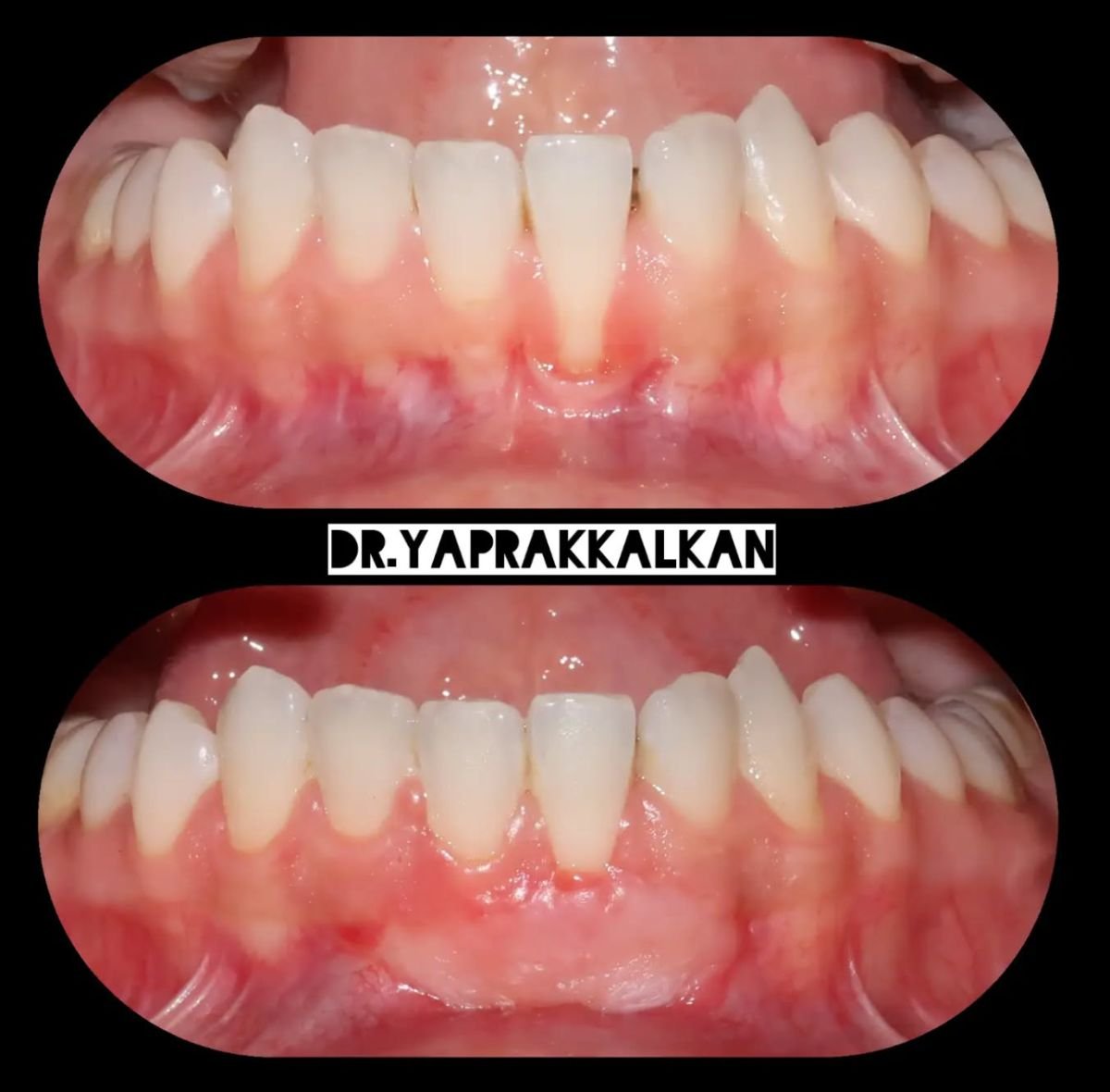 Результаты до и после операции на деснах в Esthetic Smile Academy, улучшение контура десен