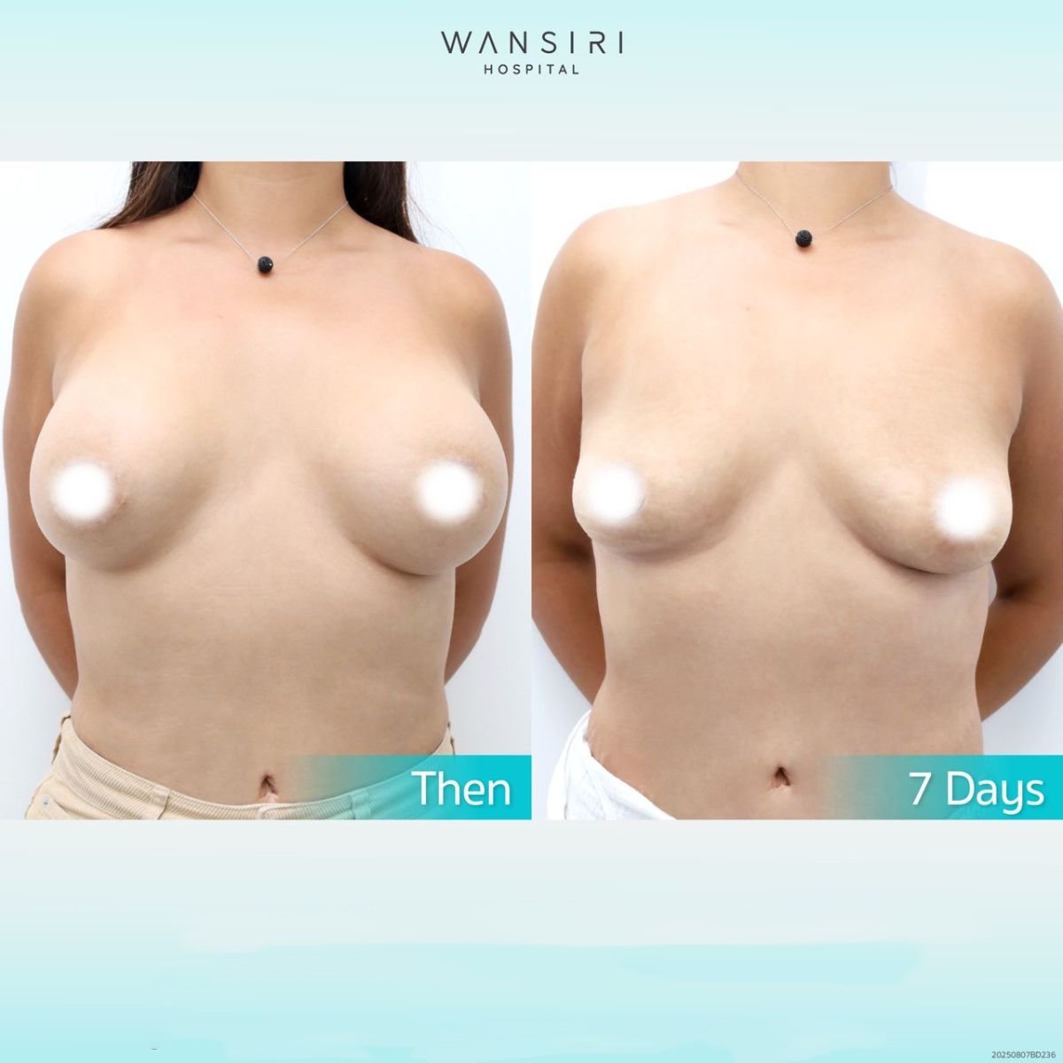 Résultats avant et après retrait d’implants mammaires à Wansiri Hospital, 7 jours après