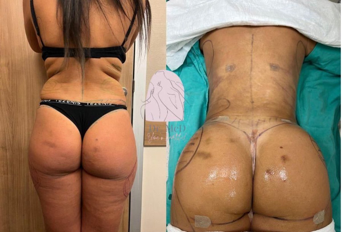 Resultados de lipofilling de glúteos antes y después en Dr. MED, contorno mejorado