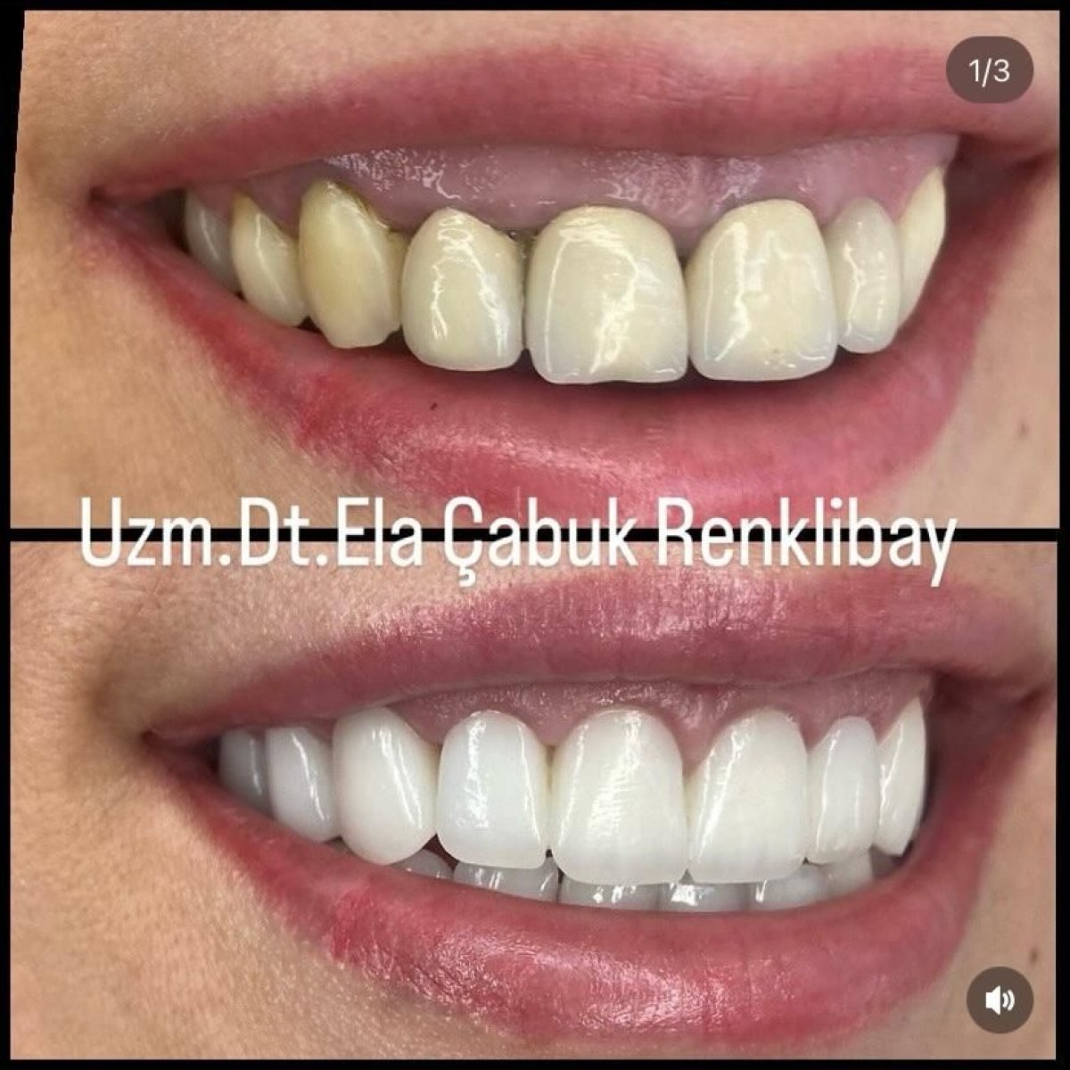 Before and after dental bonding results at Dr. Ela Cabuk Renklibay's Private Dental Clinic