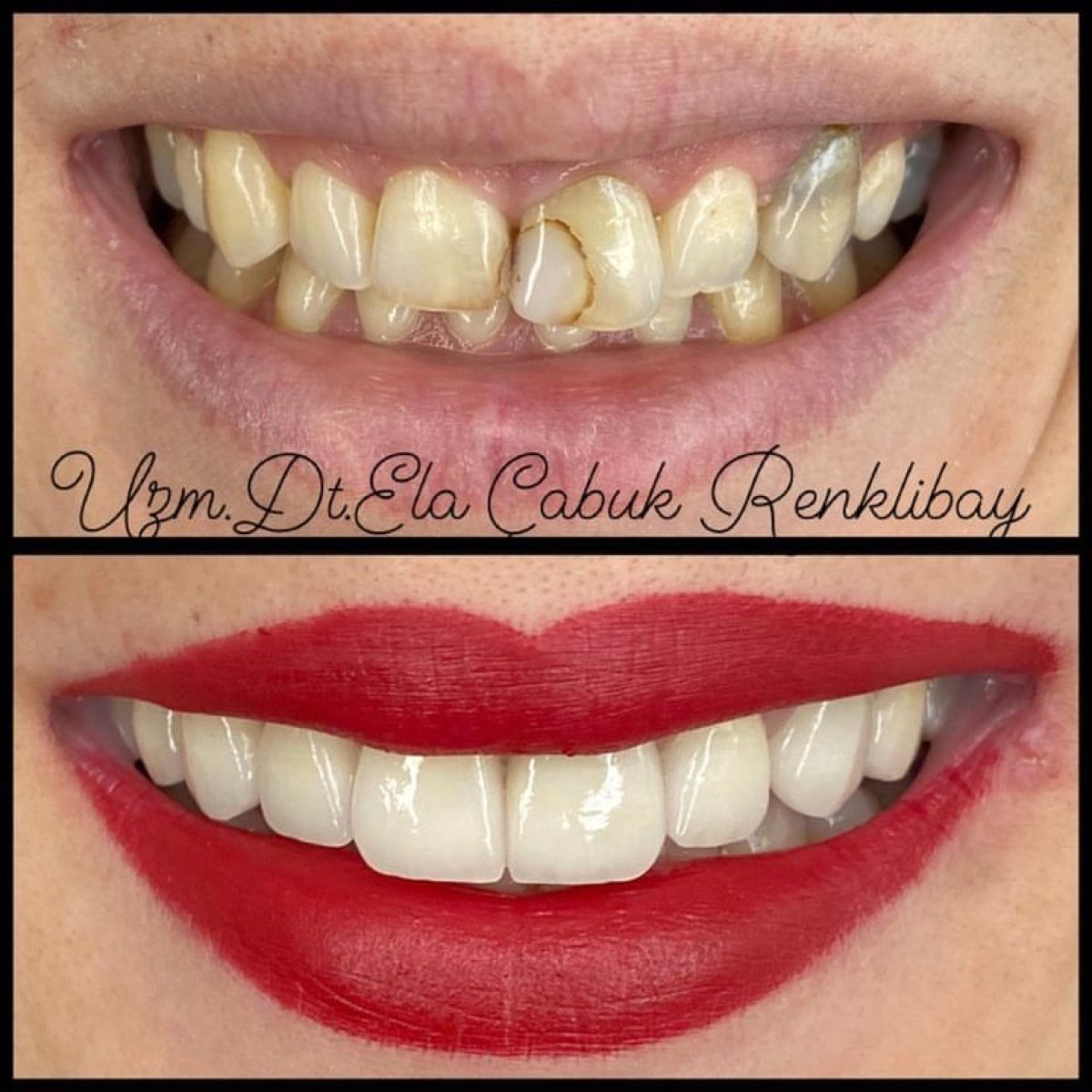 Before and after dental bonding results at Dr. Ela Cabuk Renklibay's Private Dental Clinic