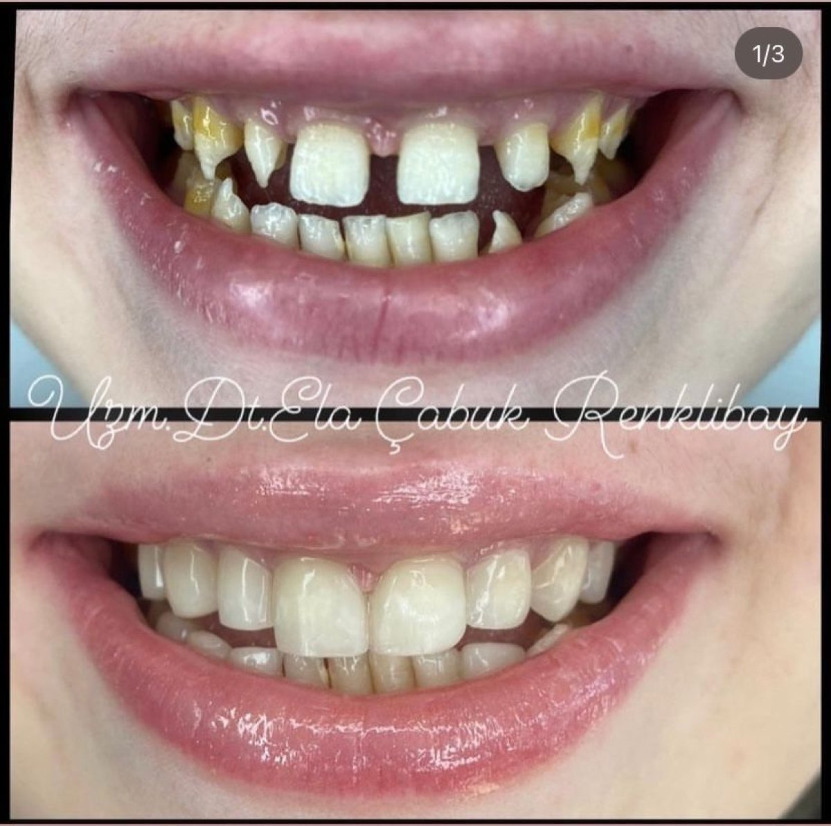 Before and after dental bonding results at Dr. Ela Cabuk Renklibay's Private Dental Clinic