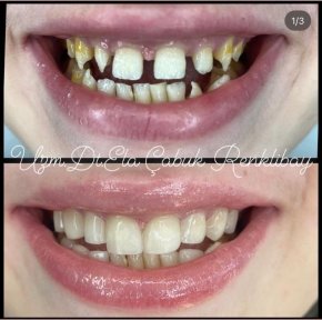 Premium Dental Bonding Treatment w Airport Transfer Included - photo 4