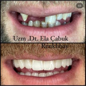 Premium Dental Bonding Treatment w Airport Transfer Included - photo 5