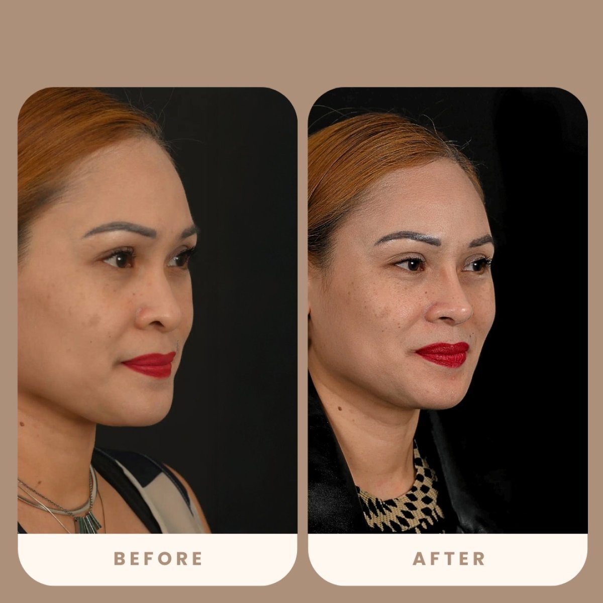 Resultados de rinoplastia antes y después en Estexper Clinic, nariz de aspecto natural