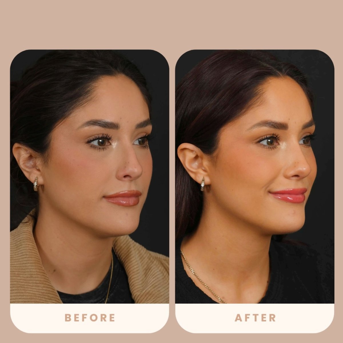 Before and after rhinoplasty results at Estexper Clinic, nose reshaping with natural look
