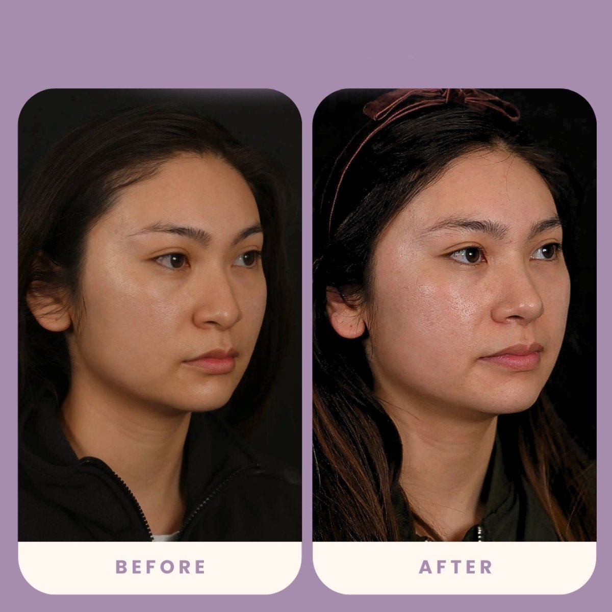 Resultados de rinoplastia antes y después en Estexper Clinic, forma de nariz mejorada