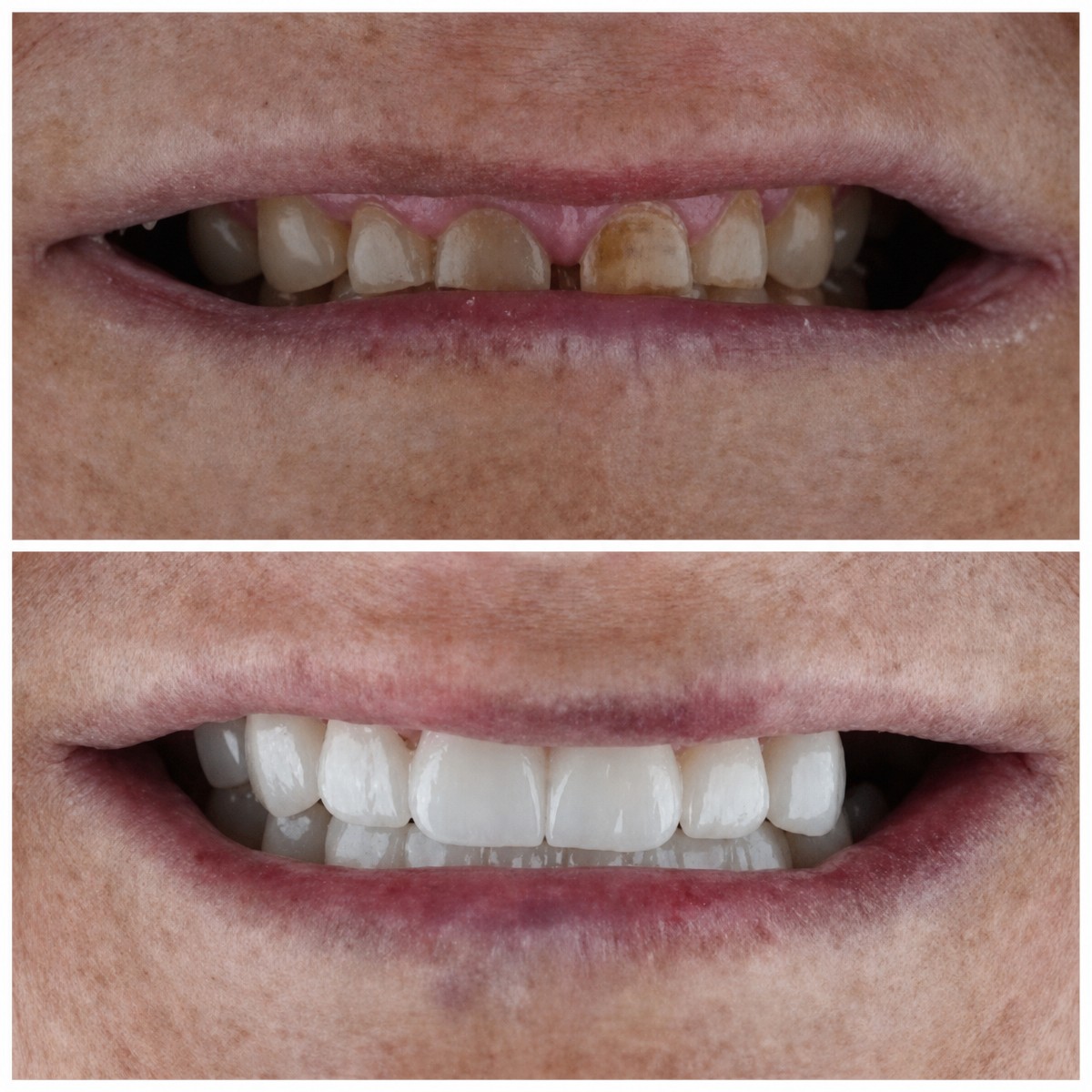 Before and after dental implant results at Nifa Dent International – restored natural smile