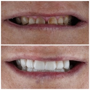All-on-6 Dental Implants with Crowns & Temporary Prosthesis — 4-Star Hotel, 9 Nights - photo 5