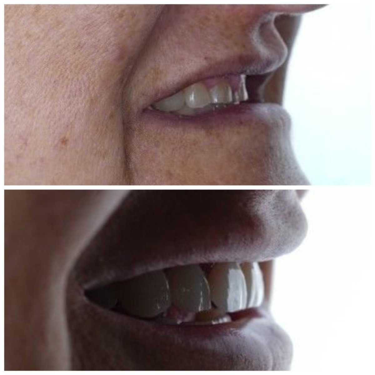 نتائج قبل وبعد زراعة الأسنان في Nifa Dent International، تحسين جمالية الابتسامة
